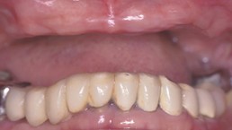 Before: Implant-supported dentures