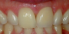 After: Single implant crown
