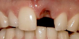 Before: Single implant crown